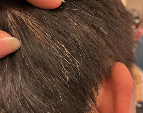 什么是營(yíng)養(yǎng)性灰白發(fā)？