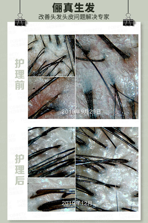 頭油、頭癢